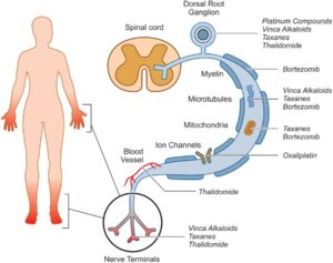 Peripheral Polyneuropathy